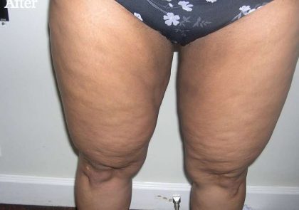 Liposuction Before & After Patient #2870