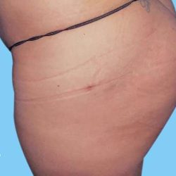 Buttock Augmentation Before & After Patient #2444