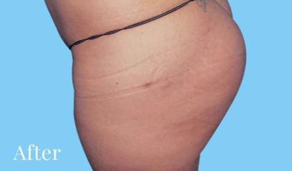 Buttock Augmentation Before & After Patient #2444