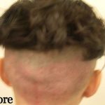 Hair Restoration Before & After Patient #2787