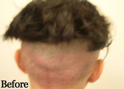 Hair Restoration Before & After Patient #2787