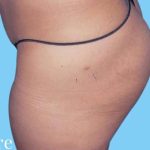 Buttock Augmentation Before & After Patient #2444