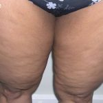 Liposuction Before & After Patient #2870