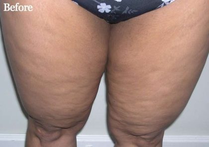 Liposuction Before & After Patient #2870