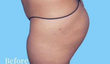 Buttock Augmentation Before & After Patient #2444