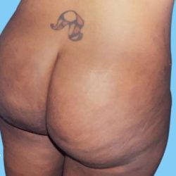 Buttock Augmentation Before & After Patient #2420