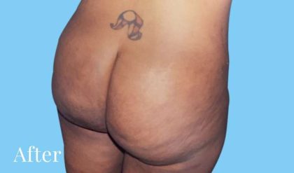 Buttock Augmentation Before & After Patient #2420