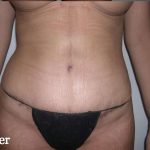 Liposuction Before & After Patient #2852