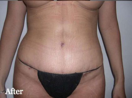 Liposuction Before & After Patient #2852