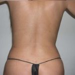 Liposuction Before & After Patient #2852