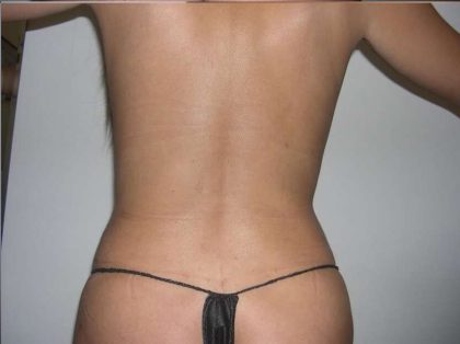 Liposuction Before & After Patient #2852