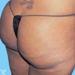 Buttock Augmentation Before & After Patient #2420