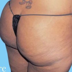 Buttock Augmentation Before & After Patient #2420