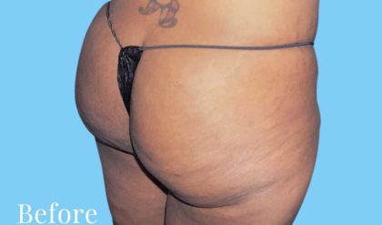 Buttock Augmentation Before & After Patient #2420