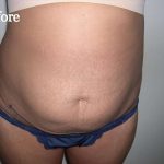 Liposuction Before & After Patient #2852