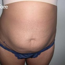 Liposuction Before & After Patient #2852