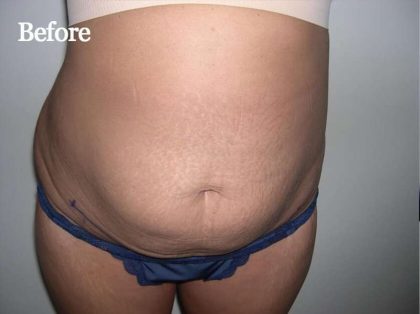 Liposuction Before & After Patient #2852