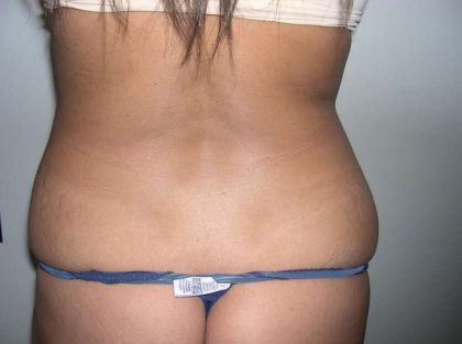 Liposuction Before & After Patient #2852