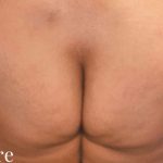 Buttock Augmentation Before & After Patient #2438
