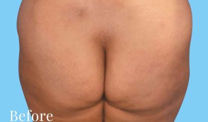 Buttock Augmentation Before & After Patient #2438