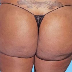 Buttock Augmentation Before & After Patient #2432