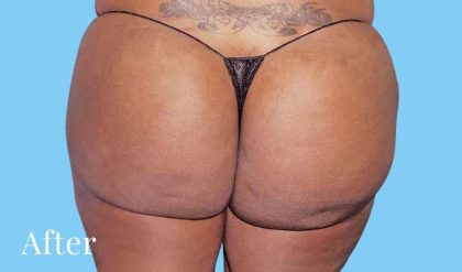 Buttock Augmentation Before & After Patient #2432