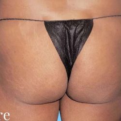 Buttock Augmentation Before & After Patient #2432