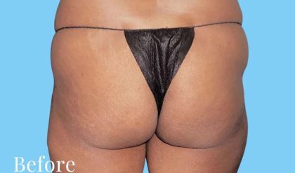 Buttock Augmentation Before & After Patient #2432