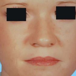 Otoplasty Before & After Patient #2559