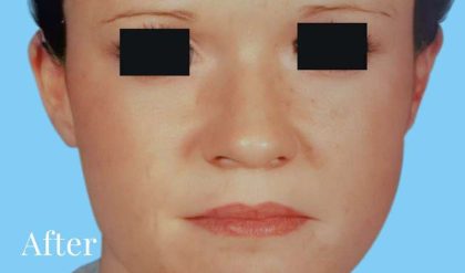 Otoplasty Before & After Patient #2559