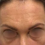 Eyebrow Restoration Before & After Patient #2594