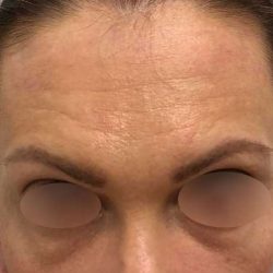 Eyebrow Restoration Before & After Patient #2594