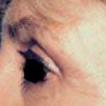 Eyelid Surgery Before & After Patient #2623