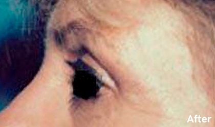 Eyelid Surgery Before & After Patient #2623
