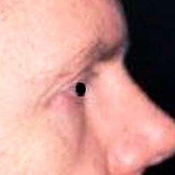 Eyelid Surgery Male Before & After Patient #2635