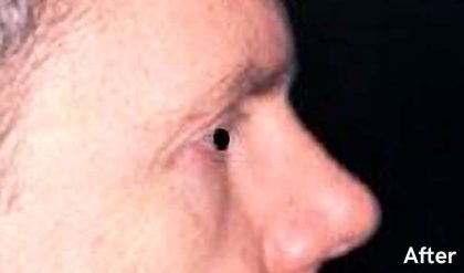 Eyelid Surgery Male Before & After Patient #2635