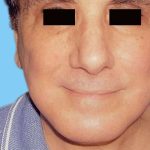 Facelift Male Before & After Patient #2671