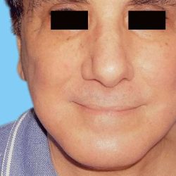 Facelift Male Before & After Patient #2671