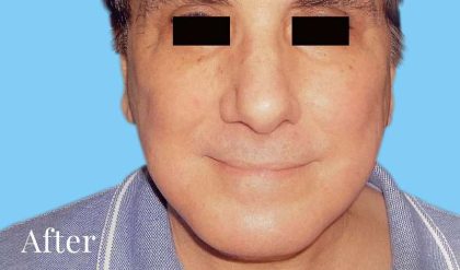 Facelift Male Before & After Patient #2671