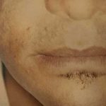 Fat Transfer Male Before & After Patient #2692
