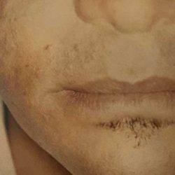 Fat Transfer Male Before & After Patient #2692