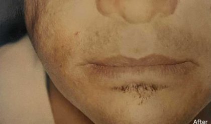 Fat Transfer Male Before & After Patient #2692