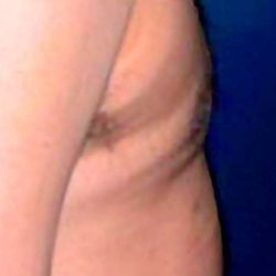 Gynecomastia Before & After Patient #2719