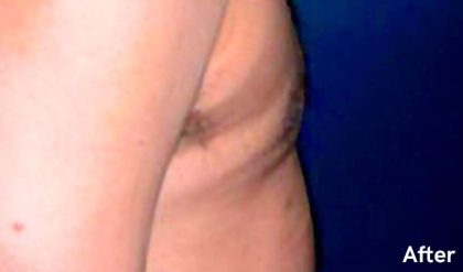Gynecomastia Before & After Patient #2719