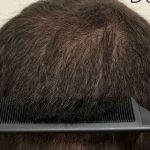 Hair Restoration Before & After Patient #2799
