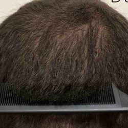 Hair Restoration Before & After Patient #2799