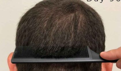 Hair Restoration Before & After Patient #2799