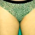 Liposuction Before & After Patient #2882