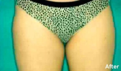 Liposuction Before & After Patient #2882