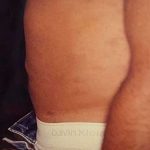 Liposuction Male Before & After Patient #2915